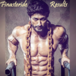 Finasteride Results