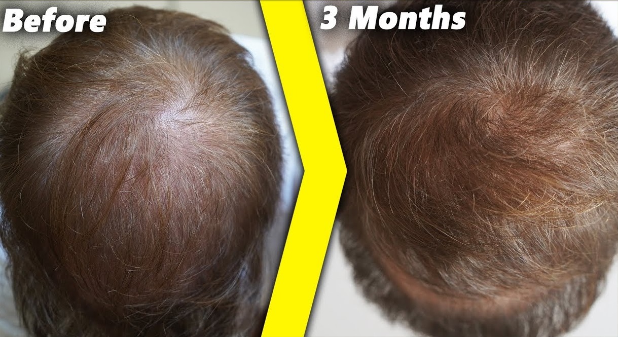 finasteride-results-before-after